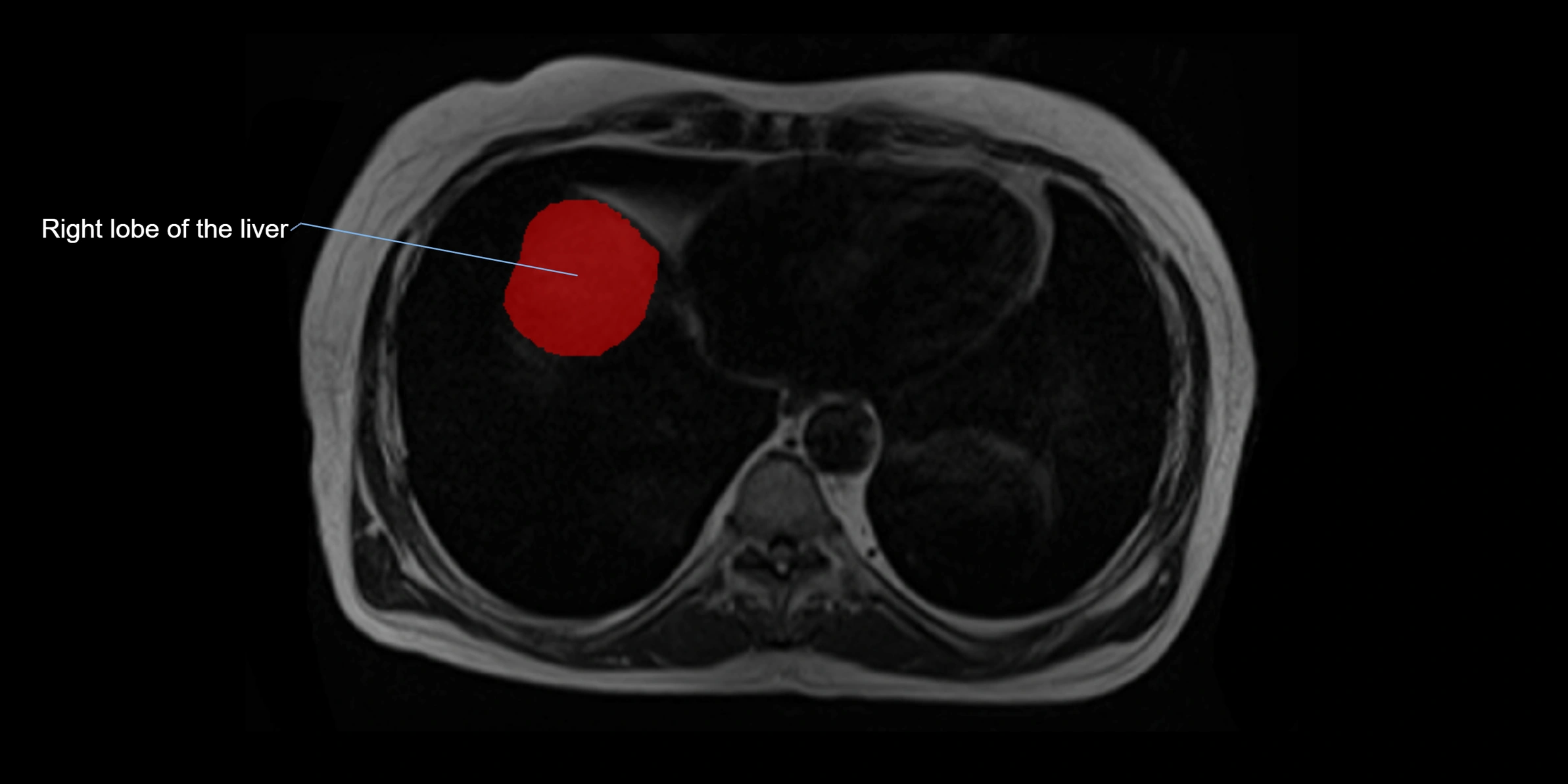 MRI liver lobe axial cross sectional 3T radiology  image-img-00001-00002.webp